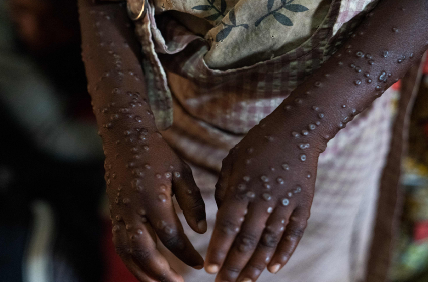 Burundi : Le Mpox en recul